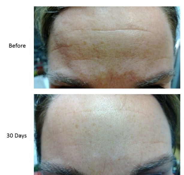 nerium before and after