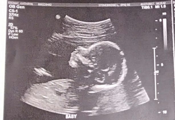 baby cormac ultrasound