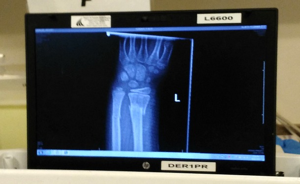 broken-bone-x-ray